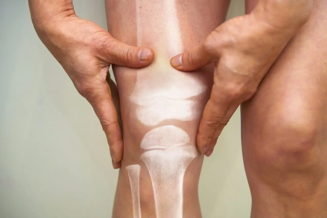 Osteoporosi: quali segnali precoci non sottovalutare per la salute delle ossa